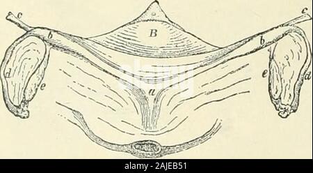 A Reference handbook of the medical sciences : embracing the entire range  of scientific and practical medicine and allied science. Fig. 1334.. Fig.  43^5. Figs. 4334 and 433.).—Rudimentary Uterus. (After Langenbcck.)