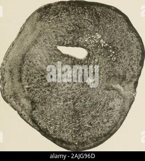 Transactions . PLATE 1, POLYPOID ANGIOMA OF THE EAR. RICHARDS. Transverse section through base of the tumor. J^o^. PLATE 2, POLYPOID ANGIOMIA OF THE EAR. RICHARDS. Transverse section through middle of the tunnor. ^^v 3 Stock Photo