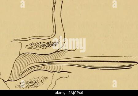 A text-book of the diseases of the ear for students and practitioners . of a probe. This procedure is suitable also for the removal of larger growths 632 DISEASES OF THE EAR with thin pedicles. For the removal of these growths the knifeis pushed to the place where the polypi arise, and the ring ispressed against the roots, which are cut through by the quickwithdrawal of the instrument. If polypoid growths on the superior portion of the tympanicmembrane are touched with a probe, the handle of the malleusmay sometimes be recognised surrounded by granulation tissue(Borberg); if the malleus is car Stock Photo