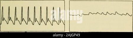 An index of symptoms with diagnostic methods . Normal Pulse.. Aortic Regurgitation. Mitral Stenosis Stock Photo