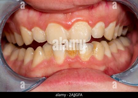 Plaque of the patient, stone. Dentistry treatment dental plaque, professional oral hygiene. The concept of harm to smoking and cleaning teeth Stock Photo