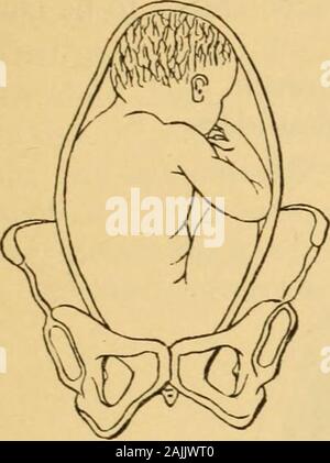 A manual of practical obstetrics . Breech presentation—legs extended ...