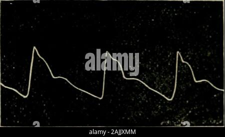 Pulse Trailing Tracings of pulse in disease Stock Photo - Alamy