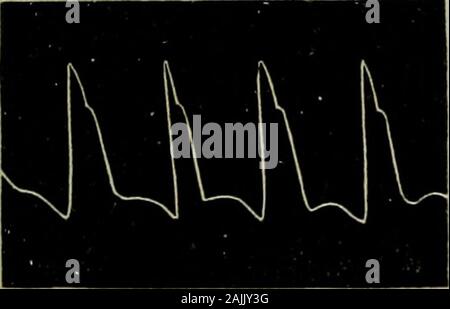 The physical signs of cardiac disease, for the use of clinical students . Fig. 26. Figs. 25 and 26.—Pulse tracings from a case of heart-failure. Fig. 26 represents the pulse after recovery. (Case reported in Lancet, Aug. 14th, 1886.). Stock Photo