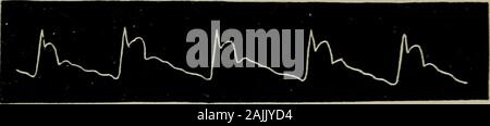 The physical signs of cardiac disease, for the use of clinical students . Fig.. Fig. 26. Figs. 25 and 26.—Pulse tracings from a case of heart-failure. Fig. 26 represents the pulse after recovery. (Case reported in Lancet, Aug. 14th, 1886.) Stock Photo