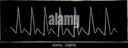 The physical signs of cardiac disease, for the use of clinical students . 6th Dec. Fig. 24. Figs. 18—24 represent pulse tracings taken in a case of heart-failure occurring during the-course of chronic Brights disease. The patient made a good recovery from his licart-failure. The tracings shows a progressive increase of pulse-tension. (Case reported inMedical Chronicley Jan., 1888.). Fig. Stock Photo