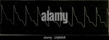 The physical signs of cardiac disease, for the use of clinical students . Fig.. Fig. 14. Figs. 13 and 14 (Mahomed) represent the right and left radial pulses respectivelj- in a.case of aneurism of the right axiliary artery. The former is extremely aneurismal iacharacter. Stock Photo