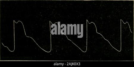 The physical signs of cardiac disease, for the use of clinical students . Fig. 7.—(Mahomed.) Tracing of pulse in aortic legurgitation due toendocarditic disease.. Fig. 3.— (Mahomed.) Pulse ia case of aortic regurgitation, due to aortitis deformans. Stock Photo