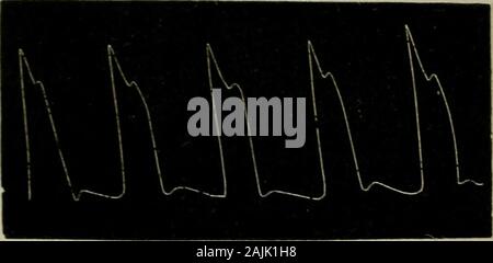 The physical signs of cardiac disease, for the use of clinical students . Fir,. 6.—(Mahomed.) Tracing showingl)ronoiinccd tidnl and dicrotic waxes. APPENDIX —THE PULSE.. Fig. 7.—(Mahomed.) Tracing of pulse in aortic legurgitation due toendocarditic disease. Stock Photo