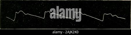 The physical signs of cardiac disease, for the use of clinical students . succeeds. This wave terminates with theaortic notch (B) which indicates the end of systole and the beginning of diastole.The elevation immediately following this notch is the dicrotic wave. A linedrawn through the lower extremities of the series of upstrokes is called therespiratory line. The tracing represents a pulse of considerable tension, and itwill be noticed that the tidal wave rises above the dotted line drawn from thesummit of the upstroke to the aortic notch. The aortic notch, again, is at aconsiderable height Stock Photo