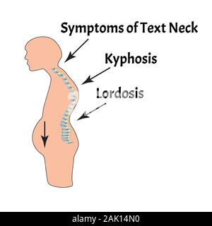 The position of the spine with lordosis, kyphosis. Text Neck Syndrome. Spinal curvature, kyphosis, lordosis, scoliosis, arthrosis. Poor posture and Stock Vector
