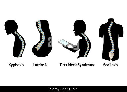 The position of the spine with lordosis, kyphosis. Text Neck Syndrome. Spinal curvature, kyphosis, lordosis, scoliosis, arthrosis. Poor posture and Stock Vector