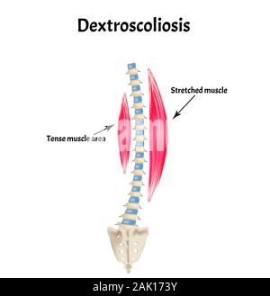 scoliosis Dextroscoliosis. Spinal curvature, kyphosis, lordosis, scoliosis, arthrosis. Infographics. Vector illustration on isolated background. Stock Vector