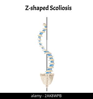 Z-shaped scoliosis. Dextroscoliosis. Levoscoliosis. Spinal curvature, kyphosis, lordosis, scoliosis, arthrosis. Infographics. Vector illustration on Stock Vector