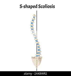 S-shaped scoliosis. Dextroscoliosis. Levoscoliosis. Spinal curvature, kyphosis, lordosis, scoliosis, arthrosis. Infographics. Vector illustration on Stock Vector