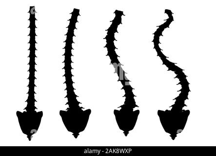 Types of Scoliosis. C, S, Z shaped scoliosis. Dextroscoliosis. Levoscoliosis. Spinal curvature, kyphosis, lordosis, arthrosis. Infographics. Vector Stock Vector