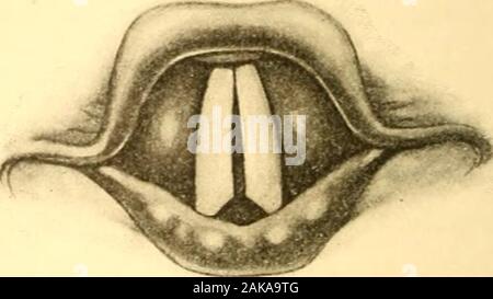 anterior commissure larynx
