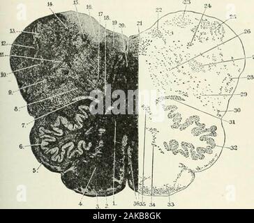 A Reference handbook of the medical sciences : embracing the entire range  of scientific and practical medicine and allied science. Fig. 1334.. Fig.  43^5. Figs. 4334 and 433.).—Rudimentary Uterus. (After Langenbcck.)