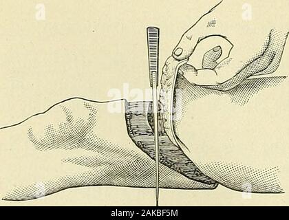 A manual of modern surgery : an exposition of the accepted doctrines and approved operative procedures of the present time, for the use of students and practitioners . Oblique incision : the upper end made by cuttingacross a fold of skin raised up between the fingerand thumb. (Kochee.) Fig. 457.. Oblique incision : position of knife in order grad-ually to carry the incision deeper through the softparts of the flap. ( Kochee. ) Stock Photo