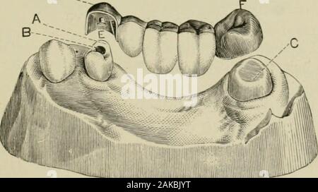 A practical treatise on artificial crown- and bridge-work . also being considerably retrenched; D, the crown-plate of al.artial cap, made of pure gold, soldered with 20-carat gold, andso constructed as to cover every portion of the tooth except its Fro. 485.D-. buccal surface, the free edge passing up under the gum; E, aritaining-pin adapted to the opening B; F, the gold cap for the molar. Fig. 480. Stock Photo