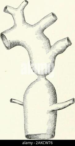 A reference handbook of the medical sciences, embracing the entire range of scientific and practical medicine and allied science . ta wassclerotic, and generally more so on the proximal sideof the narrowing. The most important secondarychanges are hypertrophy of the left ventricle and theformation of collateral circulation, the blood reachingthe lower portion of the body through the intercostalsand the abdominal aorta, through the superficial 223 BIood-Tessels, PathologicalAuatoniy of REFEREXCE HANDBOOK OF THE MEDICAL SCIEXCES epigastric and long thoracic arteries and the deepepigastric, and t Stock Photo