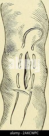 A manual of modern surgery : an exposition of the accepted doctrines and approved operative procedures of the present time, for the use of students and practitioners . Lateral anastomosis without the use of plates or buttons : first stage of the operation. (Richardson.) INTESTINAL ANASTOMOSIS. 653 Fig. 379.. Stock Photo