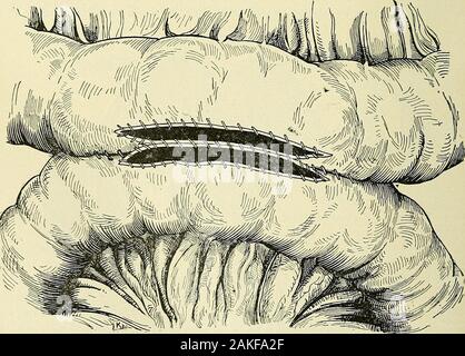 A manual of modern surgery : an exposition of the accepted doctrines and approved operative procedures of the present time, for the use of students and practitioners . Fig. 378.. Lateral anastomosis without the use of plates or buttons : first stage of the operation. (Richardson.) INTESTINAL ANASTOMOSIS. 653 Fig. 379. Stock Photo