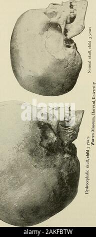 Pediatrics : the hygienic and medical treatment of children . Hydrocephalic brain. Warren Museum. Harvard University, Fig. 283 represents the hydrocephalic skull at three 3^ears in com-parison with a normal skull of the same age. The face in these cases of hydrocephalus remains about the samesize as it would be normally, but usually looks much smaller fromthe disproportionate size of the cranium, which rests upon it likea globe. Symptoms.—The symptoms of congenital internal hydrocephalusare essentially those caused by pressure. We naturally, therefore,find the fontanels bulging and fluctuating Stock Photo