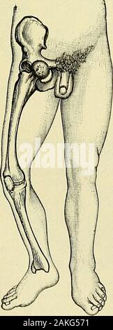 A manual of modern surgery : an exposition of the accepted doctrines and approved operative procedures of the present time, for the use of students and practitioners . Alliss test for shorteningin backward dislocation offemur. Fig. 305. Fig. 306.. Stock Photo