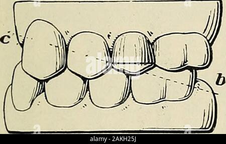 A practical treatise on mechanical dentistry . ereafter proceed as beforedirected to make the truss of the bridge and mount the teeth,except that in this case the posterior end of the truss is to be sol-dered to the molar cap. For the final attachment place a little BRIDGE DENTURES. 609 oxyphosphate or other plastic filling material in the cap to secureit firmly in position. The Hollingsworth System.—This system supplies, in the firstplace, a variety of forms for the various teeth great enough to coveralmost any case, and for the rare cases which cannot be suited directit affords a ready means Stock Photo