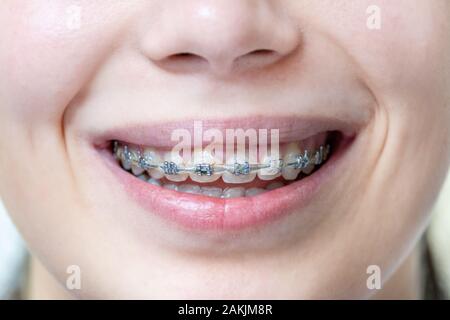 Close up view on dentist taking off black rubber bands from ceramic braces  with a help