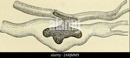 A manual of modern surgery : an exposition of the accepted doctrines and approved operative procedures of the present time, for the use of students and practitioners . Case of sacculated arteriovenous fistule of right thigh dueto gunshot wound of femoral vessels. (Authors Case.) Fig. 103. Fig. 104.. Stock Photo