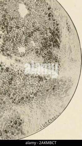 General and dental pathology with special reference to etiology and pathologic anatomy; a treatise for students and practitioners . Fig. 41.—Melanosa Stengel and Fox.) Stock Photo