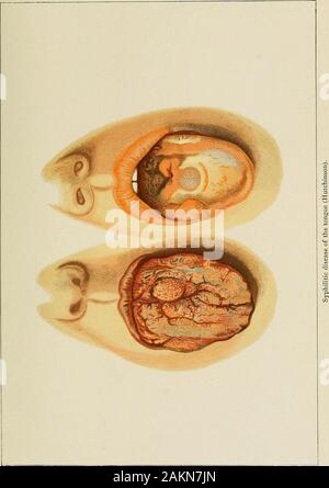 Syphilis Drawing A manual of syphilis and the venereal diseases Stock Photo - Alamy