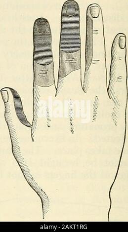 Modern surgery, general and operative . Fig. 486.—Section of median nerve; areasof anesthesia (heaT^ shading) and of dyses-thesia (light shading) on palmar surface ofhand (Bowlby). Fig. 487.—Section of median nerve; re-gions of anesthesia and dysesthesia on dorsalsurface of hand (Bowlby). fingers than in the others because the lumbricales of the first two fingers aresupplied by the median nerve. Interosseal flexion is impossible, and the op- Stock Photo