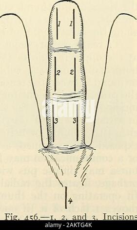 Empty Riziform Box . Modern surgery, general and operative. of the tendon-sheath with J ...