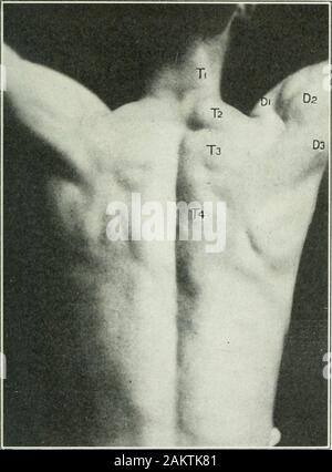 Applied anatomy and kinesiology; the mechanism of muscular movement . Fig. 33. -Abnormallposture of right scapula due to loss of the right trapezius.(Mollier.) We have noticed that the first part of the trapezius is admirablysituated for lifting the shoulders, and that when it is stimulated byelectric current it does so promptly. When we shrug the shoulders,therefore, it is natural to infer that it aids in the movement, butobservation of the kind we are considering now shows that it doesnothing of the kind, remaining in complete relaxation while themovement is being performed. To prove this we Stock Photo