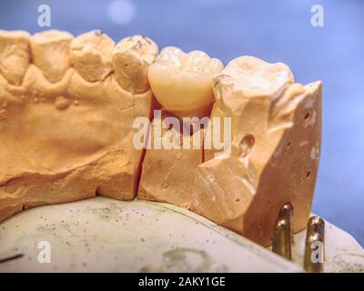 Dental prostheses in semiprocess.  Gypsum Stomatologic human jaws. Ceramic-metal crown on plaster model Stock Photo