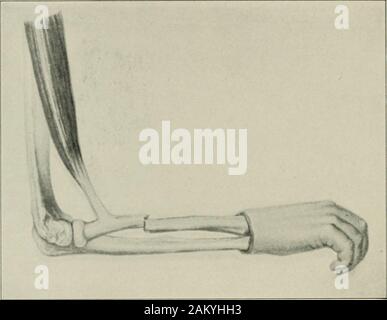 Supination/pronation of the forearm and hand occurs at which of