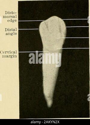 Principles and practice of operative dentistry . Mesial grooveFig. 65 ...