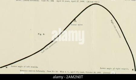 The treatment of lateral curvature of the spine : with appendix giving an analysis of 1000 consecutive cases treated by posture and exercise exclusively, without mechanical supports . PLATE II. Fg. 10. Fig- 11 Stock Photo