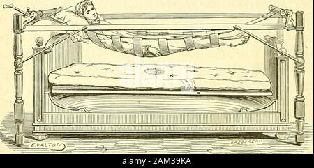 Chirurgie journalière des hopitaux de Paris : répertoire de thérapeutique chirurgicale . Fig. 384. — Matelas hydrostatique du docteur Demarquay.. Fig.r385. — Lit mécanique de Rabiot (modèle Gellé). Hamac à sangles poursoulever le malade. Stock Photo