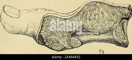 A system of surgery . ods, at the optionof the surgeon. In exceptional circumstances the amputation mightbe successfully accomplished just below the knee, through the 920 DISEASES OF BONES. tibia, but great care must be taken that the soft parts are reallyfree from infiltration. If the disease be situated in the upper thirdof tibia, the amputation must be done through the lower third ormiddle of thigh, according to the extent of growth. An endostealsarcoma of tibia may be removed by amputation, just above thedisease. A re-section would leave a useless limb. Fibula.—A periosteal sarcoma should Stock Photo