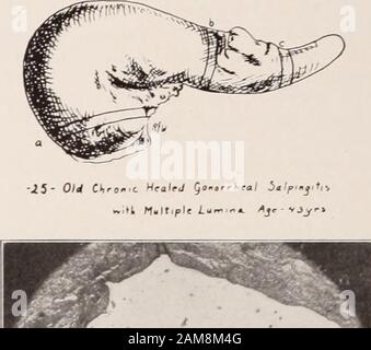 Transactions of the American Association of Obstetricians and Gynecologists for the year ... . try* Case XXIV. Drawing of gross specimen 274 JAMES E. DAVIS,. Stock Photo