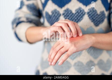 Young woman scratching her itchy hand. Concept skin problem, allergy and dermatology Stock Photo