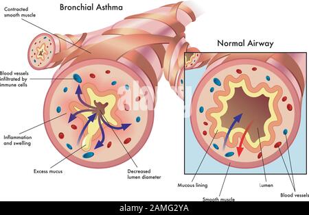 Medical illustration of the effects of bronchial asthma. Stock Vector