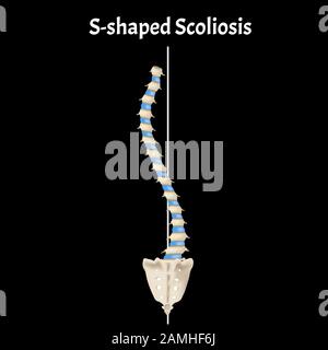 S-shaped scoliosis. Dextroscoliosis. Levoscoliosis. Spinal curvature, kyphosis, lordosis, scoliosis, arthrosis. Infographics. Vector illustration. Stock Vector