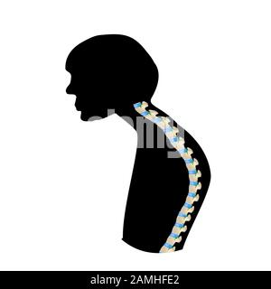 The position of the spine with kyphosis. Black and white silhouette icon. Spinal curvature, kyphosis, lordosis, scoliosis, arthrosis. Improper posture Stock Vector