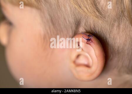 Torn wounds with stitches one child ear. close-up of laceration human ear with suture. wound stitches. Medical, surgical concept. Stock Photo