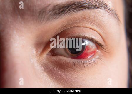 Hemorrhage in the eye of a woman. Bruising of the cornea. Macro. Stock Photo